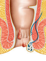 Schéma du rectum avec des hémorroïdes